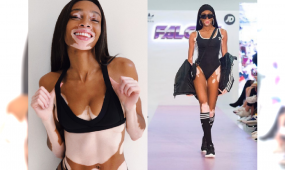 Chora na BIELACTWO modelka Winnie Harlow zostanie "aniołkiem" luksusowej marki bieliźniarskiej!