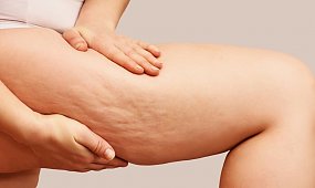 Peeling antycellulitowy - jakie ma właściwości i czy naprawdę działa?