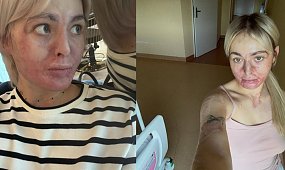 Płonęła żywcem po wybuchu biokominka. Dziś 27-latka w bikini imponuje internautom [zdjęcia]