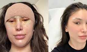27-letnia Agata Lewandowska zdejmuje szwy po liftingu. "Zrobiło mi się czarno", fani nie gryzą się w język [zdjęcie]