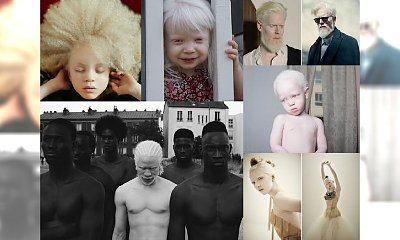 Te osoby z albinizmem są po prostu niewyobrażalnie piękne! Prawie 30 wyjątkowych fotografii, które musisz zobaczyć!