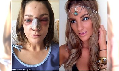 Wydała 19 tysięcy złotych na operację nosa. Czy efekt jest wart tylu pieniędzy i cierpienia?