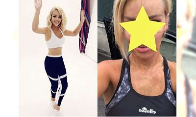 Odważnie pokazuje OSZPECONĄ twarz i szyję! Zobaczcie, jak wygląda oblana kwasem modelka BEZ MAKIJAŻU