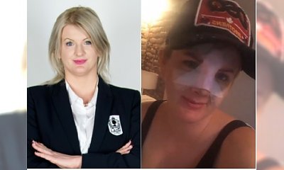 Karolina Plachimowicz z "Projektu Lady" przeszła OPERACJĘ NOSA! Pokazała się po zdjęciu gipsu. Lepiej?