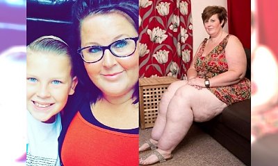 Mama na diecie bardzo schudła, lecz jej nogi wciąż były GIGANTYCZNE! Dopiero wtedy stwierdzono, że jest chora...