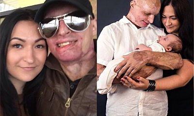Z powodu ataku kwasem został strasznie oszpecony, stracił wzrok i nigdy nie zobaczy swojego synka! Tej tragedii można było zapobiec!