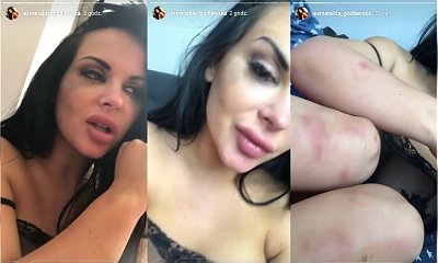 Esmeralda Godlewska ZOSTAŁA POBITA przez mężczyznę! "Kobietę można pobić, zniszczyć psychicznie, stłamsić." Pokazała siniaki i oznaki pobicia