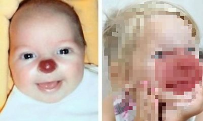 Mama urodziła dziecko z nosem klauna. Oto jak dzisiaj wygląda