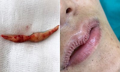 Redukcja warg: horror czy nowy trend? Przerażające zdjęcia, które zwalają z nóg