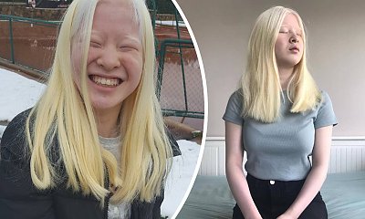 Rodzice porzucili ją ze względu na jej chorobę! Dziś Xueli Abbing ma 16 lat i podbija świat mody!