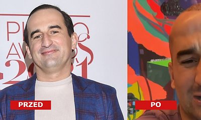 Michał Koterski zrobił sobie przeszczep włosów! Pokazał efekt! Wow! Jest nie do poznania