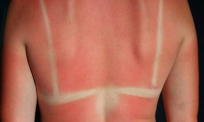 "Moja córka strasznie spiekła się na hiszpańskiej plaży. Co z tym zrobić i jak chronić się przed słońcem na wakacjach"?