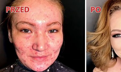 Przez ciężką postać trądziku nie mogła patrzeć w lustro. Dzięki tej metamorfozie uwierzyła, że jest piękna