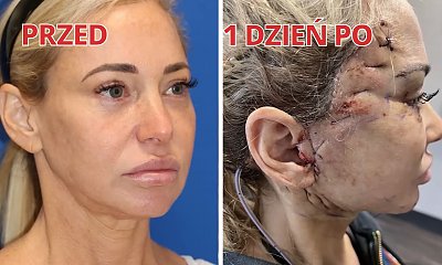 49-letnia influencerka czuła, że musi wyglądać młodziej. Postanowiła "cofnąć czas" o 10 lat