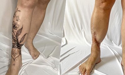 Tatuaże na bliznach - ciało zamiast szpecić, zdobi! Zobacz te piękne i niesamowite metamorfozy!