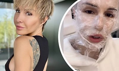 Blanka Lipińska pokazała się po zabiegu. Twarz spuchnięta, ledwo widzi
