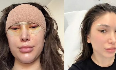 27-letnia Agata Lewandowska zdejmuje szwy po liftingu. "Zrobiło mi się czarno", fani nie gryzą się w język [zdjęcie]