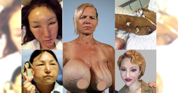 Operacje plastyczne zmieniły tych ludzi w potwory! Nieudane operacje zniekształciły ich do końca życia