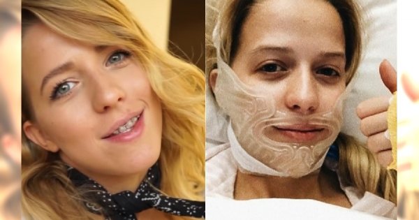 Jessica Mercedes POKAZAŁA TWARZ po operacji żuchwy