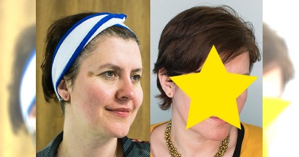 Recenzja zabiegu Derma Peel na przebarwienia i odmłodzenie skóry - zobacz efekty PRZED I PO!