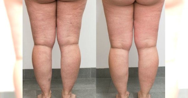 Zabieg Cellactor likwidujący CELLULIT. Zobacz efekt "przed" i "po" bez Photoshopa!