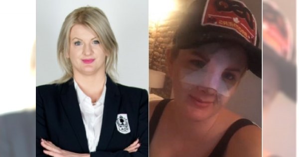 Karolina Plachimowicz z "Projektu Lady" przeszła OPERACJĘ NOSA! Pokazała się po zdjęciu gipsu. Lepiej?