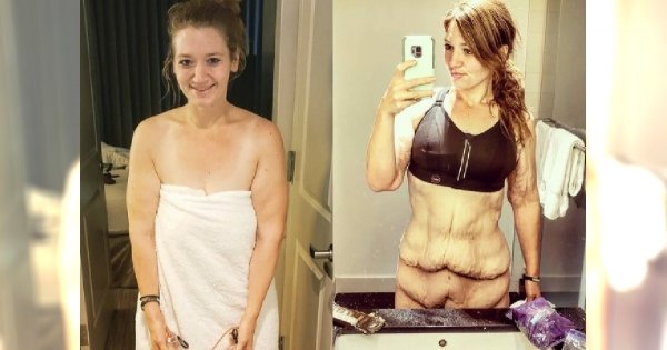 Odważnie pokazywała ciało po zrzuceniu 140 kilogramów. Po odchudzeniu zostały jej ciężkie płaty nieestetycznej skóry