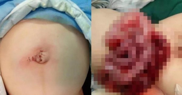 Ojciec zrobił DZIURĘ w brzuszku kilkumiesięcznego dziecka! Jego wnętrzności były na zewnątrz... W ten sposób chciał u niego pozbyć się wzdęć...