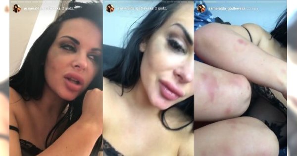 Esmeralda Godlewska ZOSTAŁA POBITA przez mężczyznę! "Kobietę można pobić, zniszczyć psychicznie, stłamsić." Pokazała siniaki i oznaki pobicia
