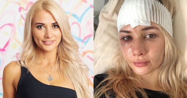 Beata Grucela z "Love Island" ma bliznę na połowie na twarzy. Pokazała jak wygląda po wypadku
