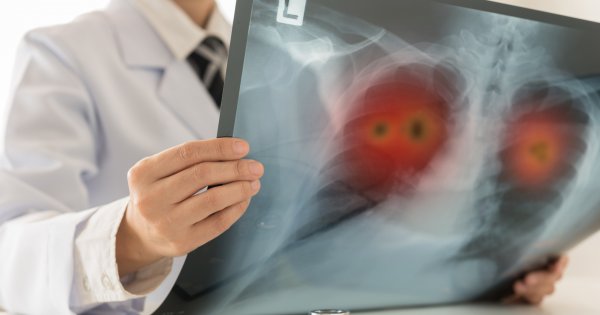 Wczesne objawy raka płuc. Masz je? Umów się do lekarza!