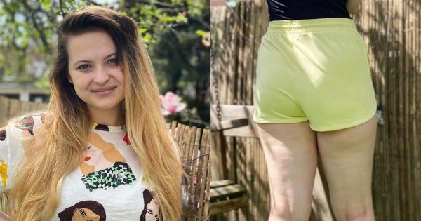 Czy kobieta z cellulitem powinna nosić shorty? Blogerka zabrała głos w tej sprawie