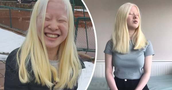 Rodzice porzucili ją ze względu na jej chorobę! Dziś Xueli Abbing ma 16 lat i podbija świat mody!