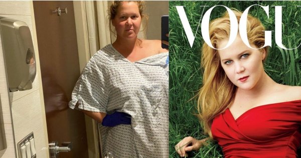 Amy Schumer usunęła macicę! Choruje na poważną chorobę...