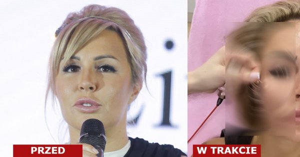 Blanka Lipińska z igłami wbitymi w twarz podczas zabiegu stymulacji włókien kolagenowych! Uwaga, drastyczne zdjęcia!
