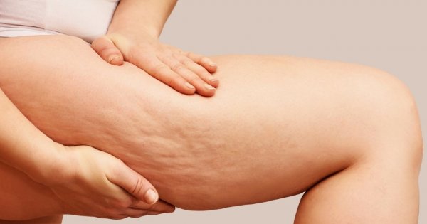 Peeling antycellulitowy - jakie ma właściwości i czy naprawdę działa?