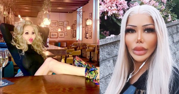 Oszpecające efekty operacji plastycznych. Brak nosa, ogromne piersi i zdeformowana twarz - niektóre zdjęcia przerażają!