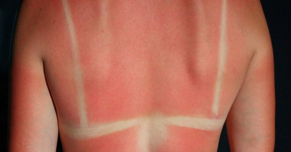 "Moja córka strasznie spiekła się na hiszpańskiej plaży. Co z tym zrobić i jak chronić się przed słońcem na wakacjach"?