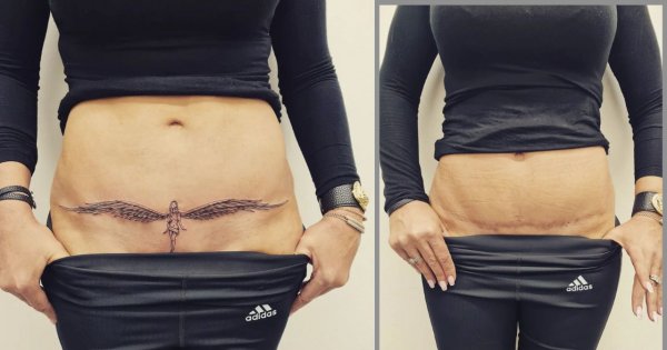 Tatuaże na bliznach: Zobacz 14 pięknych metamorfoz i zainspiruj się! [ZDJĘCIA PRZED I PO]