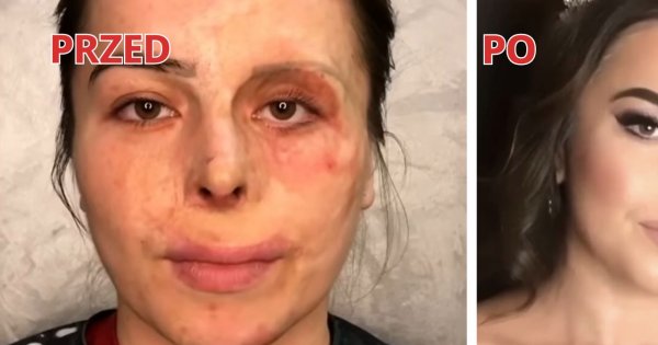 Miała twarz pełną blizn od 2 roku życia. Makijaż na jej ślub zdziałał cuda! Szokująca metamorfoza!