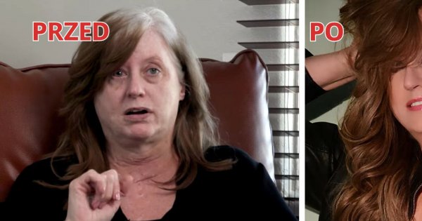 Po zamachu bombowym przeszła 50 operacji, jednak wciąż czuje się jak potwór. Szokująca metamorfoza kobiety z bliznami
