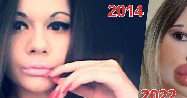 Usta Andrei wciąż rosną! Od lat ma zaszczytny tytuł posiadaczki największych ust na świecie, ale nie spoczywa na laurach