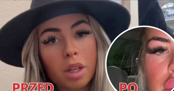 Kobieta chciała mieć ponętne usta. Efekt jest przerażający! Jak do tego doszło?