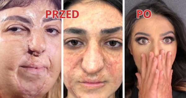 4 kobiety mają całe twarze pokryte bliznami. Zobacz ich oszałamiające metamorfozy makijażowe