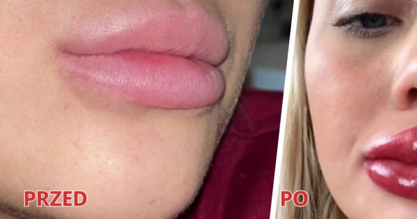 Melissa chciała podrasować kolor swoich ust. Efekt? Jak z SOR-u lub horroru