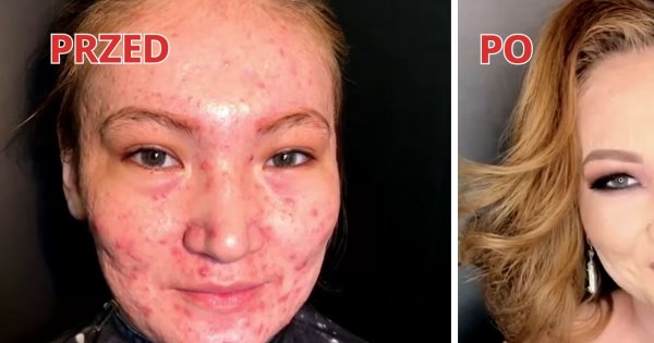 Przez ciężką postać trądziku nie mogła patrzeć w lustro. Dzięki tej metamorfozie uwierzyła, że jest piękna
