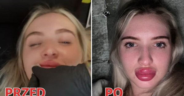 Usta jak maliny! Wiki zrobiła drugie powiększanie ust tuż po pierwszym. "Kto jej to wstrzyknął???"