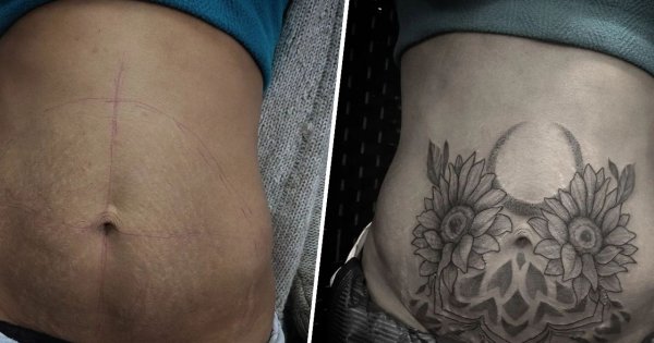 Tatuaż na bliźnie - uwolnij się od niedoskonałości i poczuj się piękna!