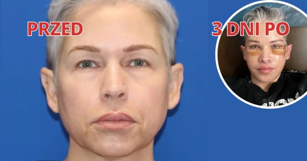 49-letnia kobieta nie cierpiała swojej obwisłej skóry. Chcąc cofnąć czas o 10 lat, poddała się operacji plastycznej
