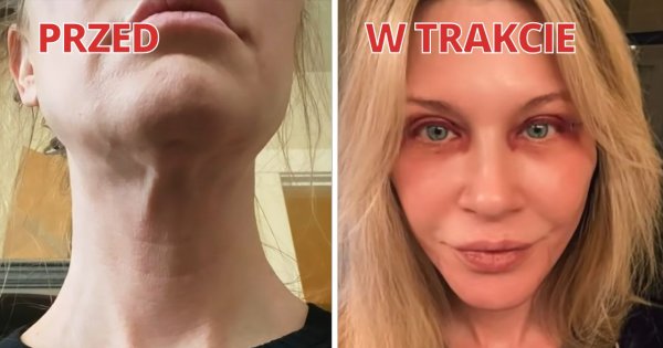 Nieudany zabieg załamał 48-letnią Penny. By poprawić wygląd, poddała się operacji plastycznej. Efekt robi wrażenie!